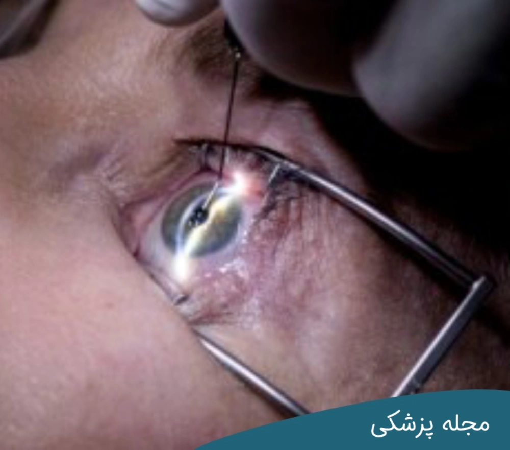 سن مناسب برای عمل لیزیک چشم - مجله پزشکی خوانساری