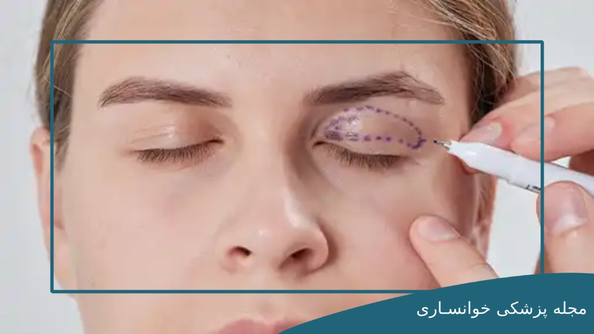 داروهای بعد از عمل بلفاروپلاستی - مجله پزشکی خوانساری