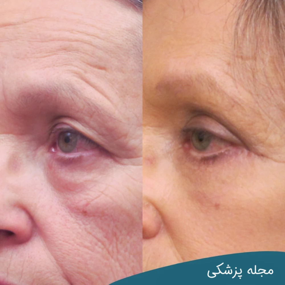 داروهای بعد از عمل بلفاروپلاستی - مجله پزشکی خوانساری