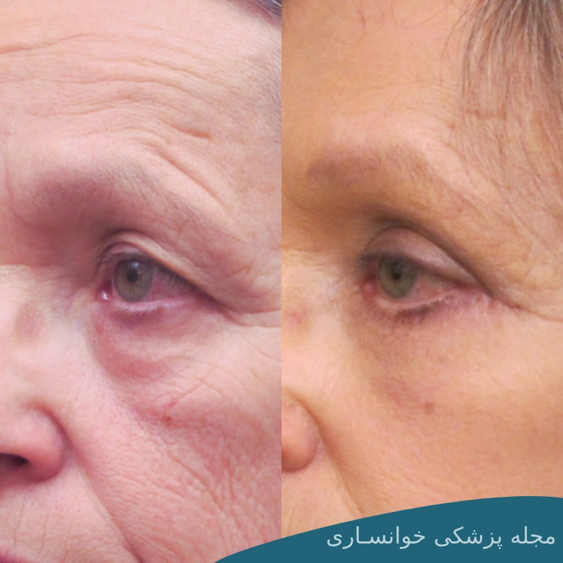 داروهای بعد از عمل بلفاروپلاستی - مجله پزشکی خوانساری
