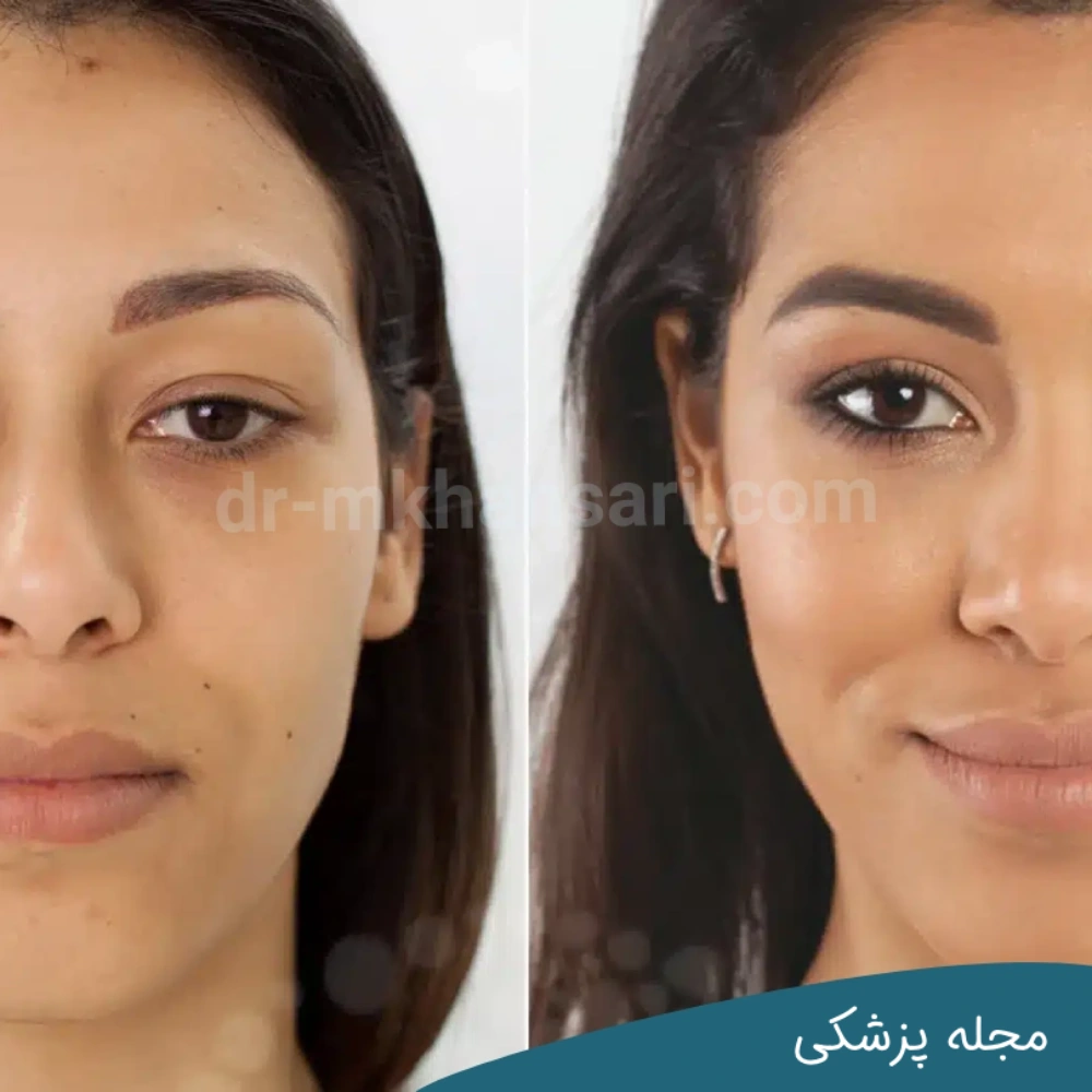 حداقل سن برای بلفاروپلاستی - مجله پزشکی خوانساری