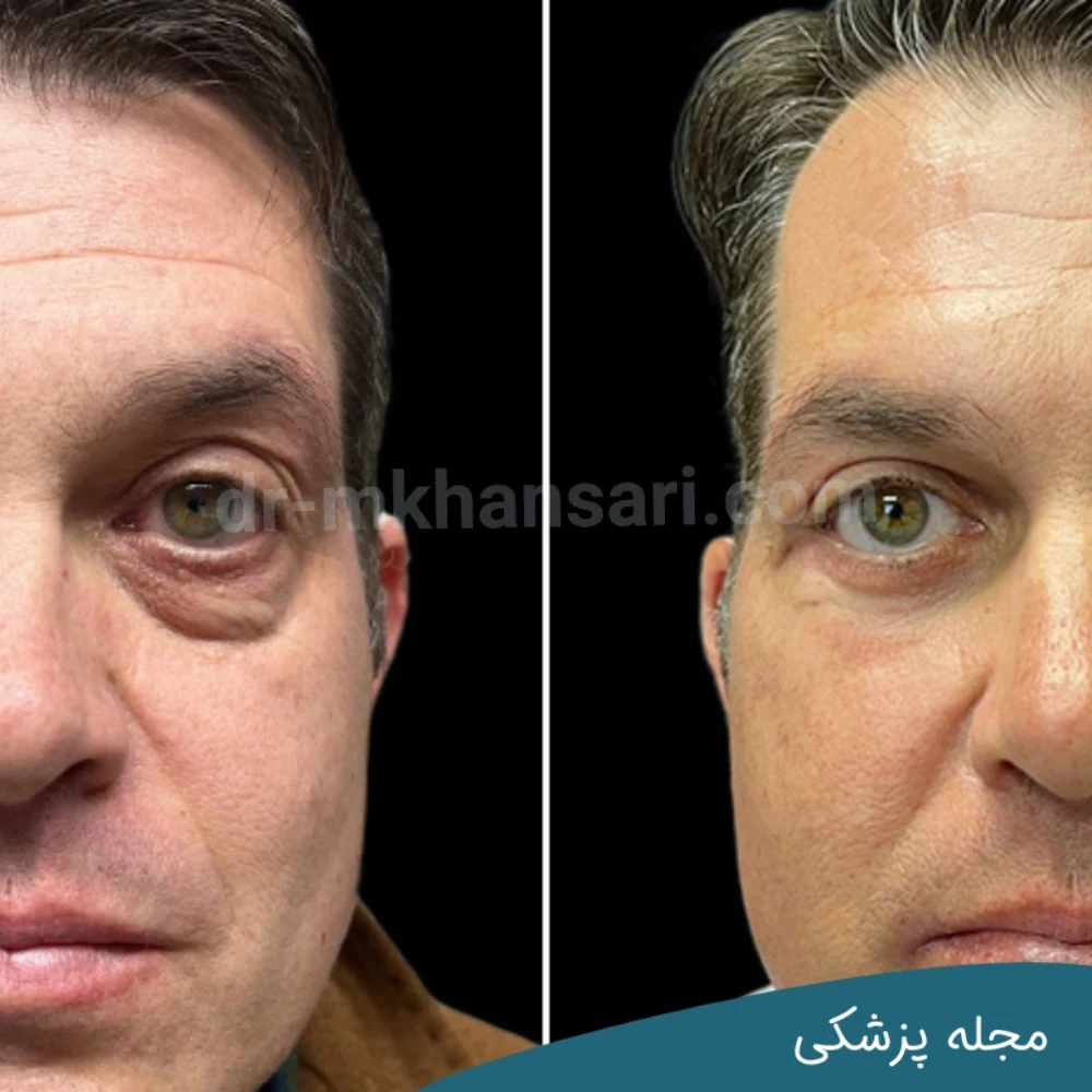 بلفاروپلاستی در سن نوجوانی - مجله پزشکی خوانساری
