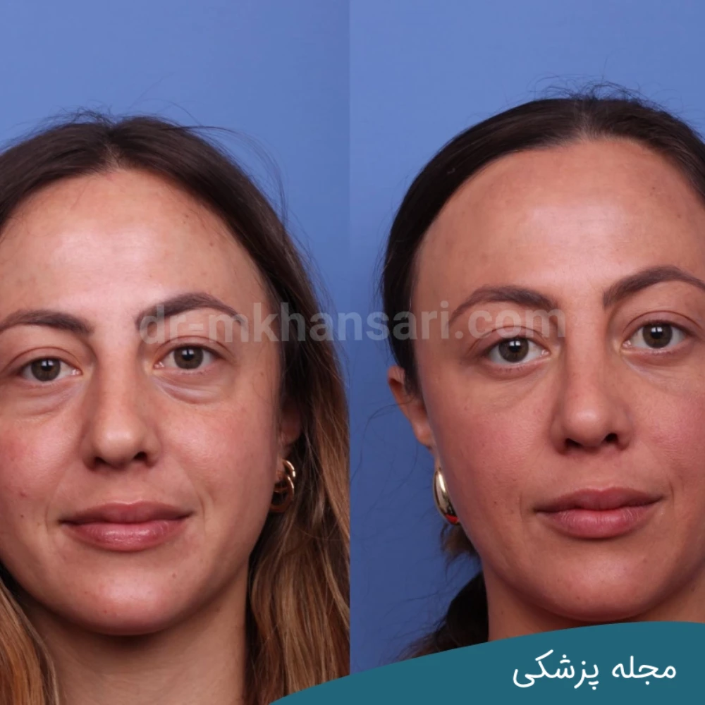 حداقل سن برای بلفاروپلاستی