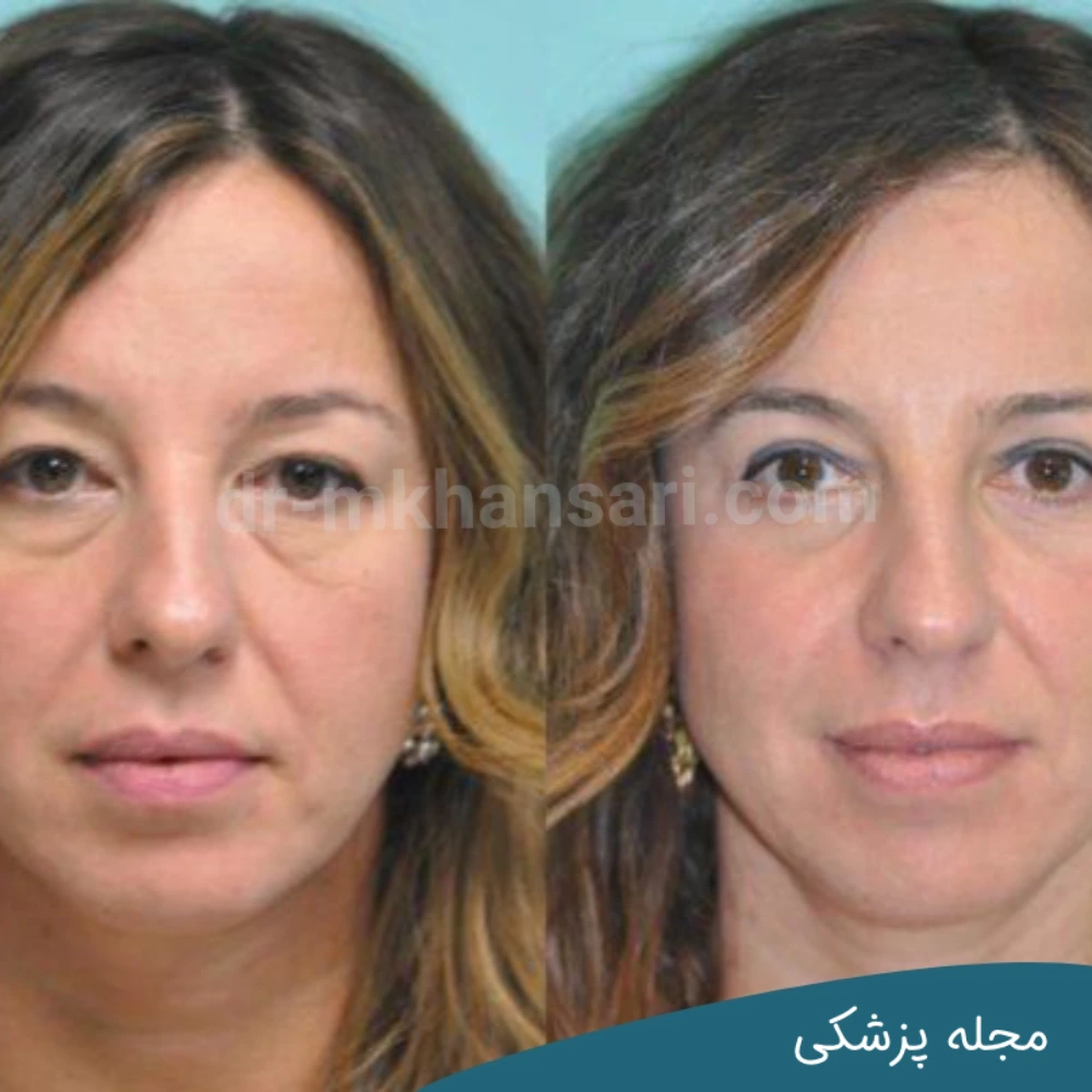 حداقل سن برای بلفاروپلاستی