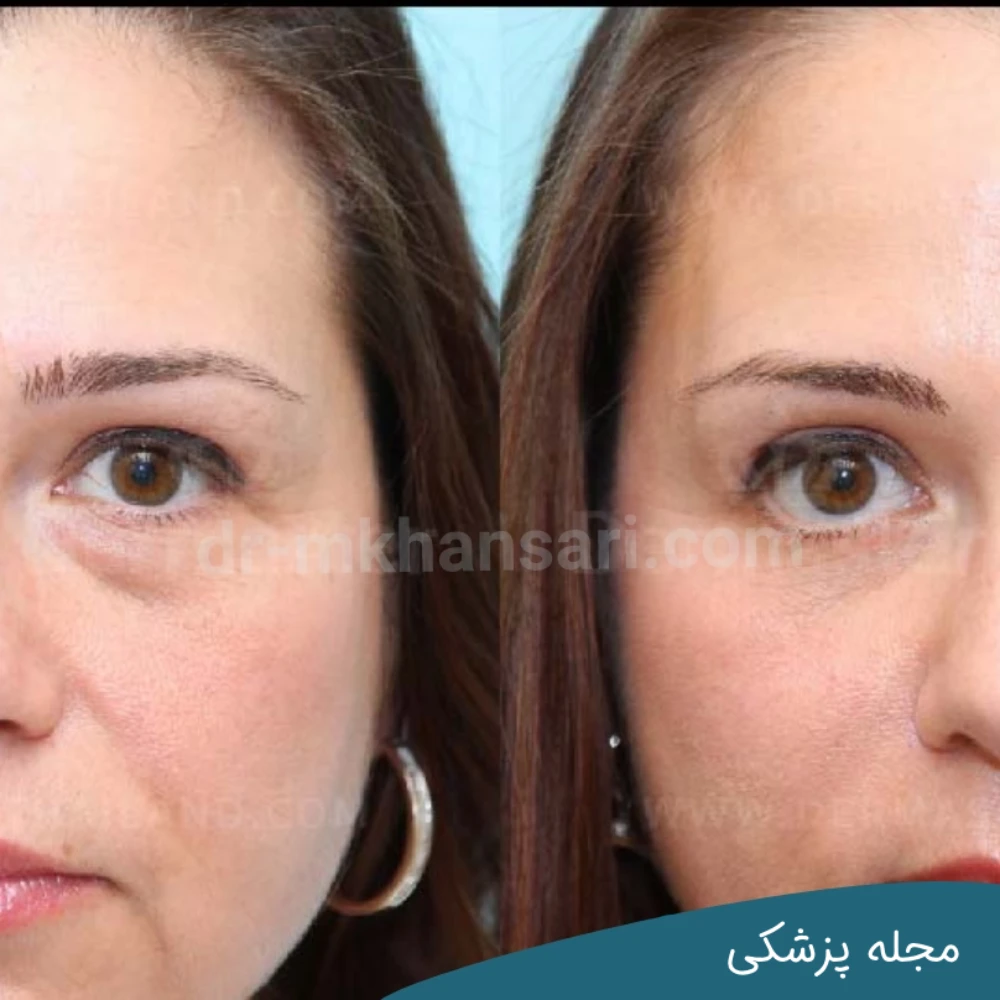 حداقل سن برای بلفاروپلاستی جهت به دست آوردن نتایج همیشگی - مجله پزشکی خوانساری
