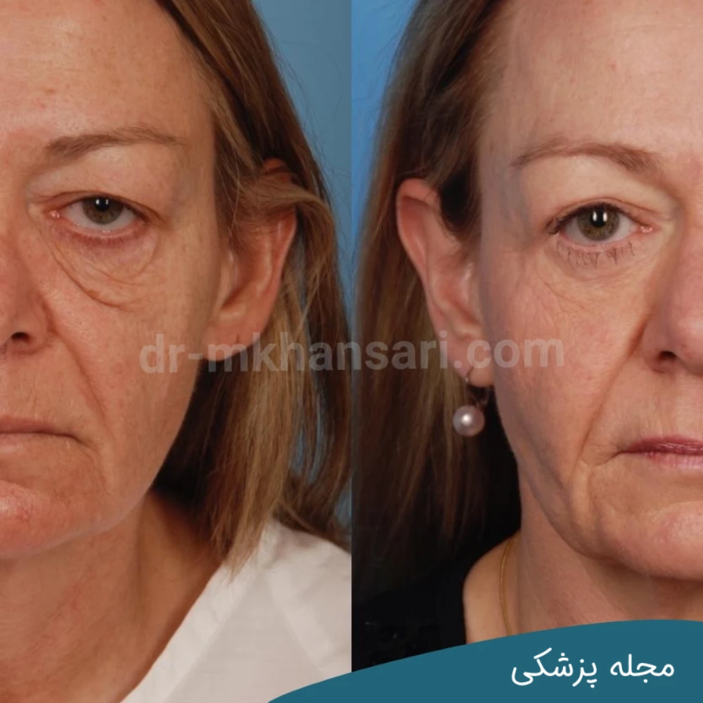 حداقل سن برای بلفاروپلاستی - مجله پزشکی خوانساری