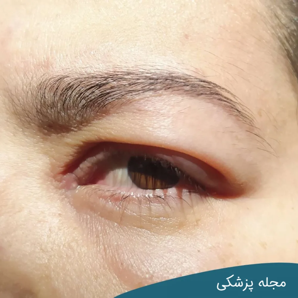 علائم همراه با پف چشم - مجله پزشکی خوانساری