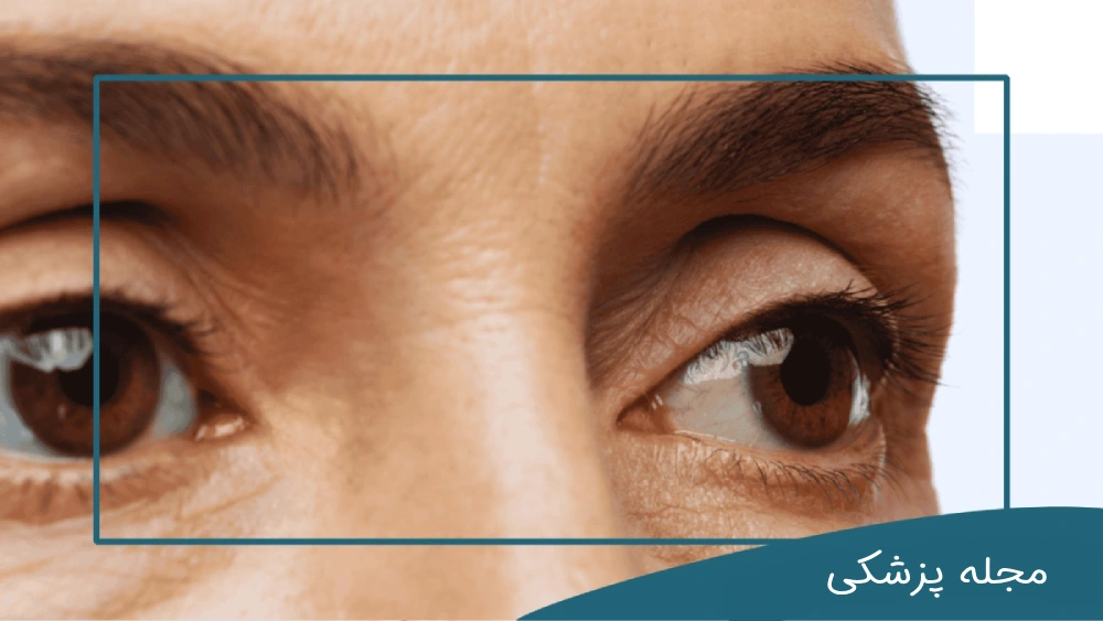 برای درمان پف چشم چه کنیم؟ مجله پزشکی خوانساری