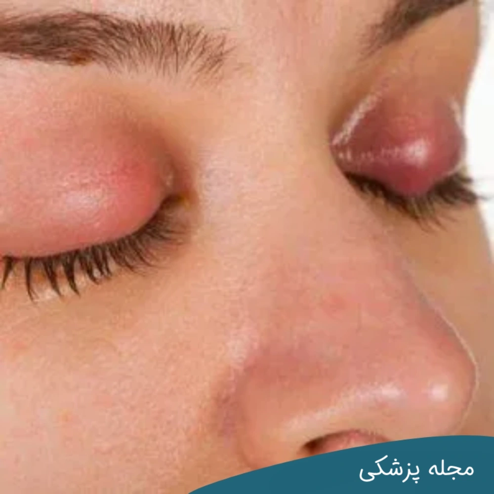 اختلالات تیروئید دلیل پف چشم - مجله پزشکی خوانساری