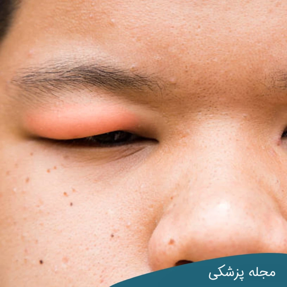 سندرم نفروتیک علت پف چشم - مجله پزشکی خوانساری