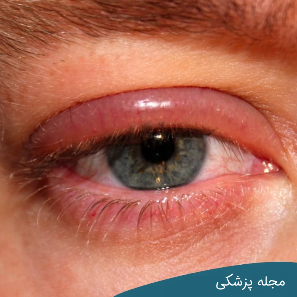 سندرم نفروتیک علت پف چشم - مجله پزشکی خوانساری