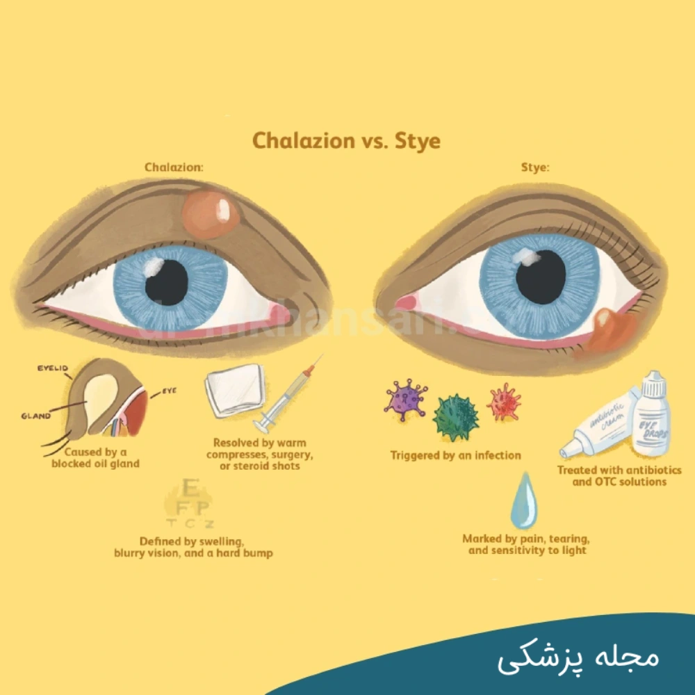 تفاوت شالازیون و گل مژه