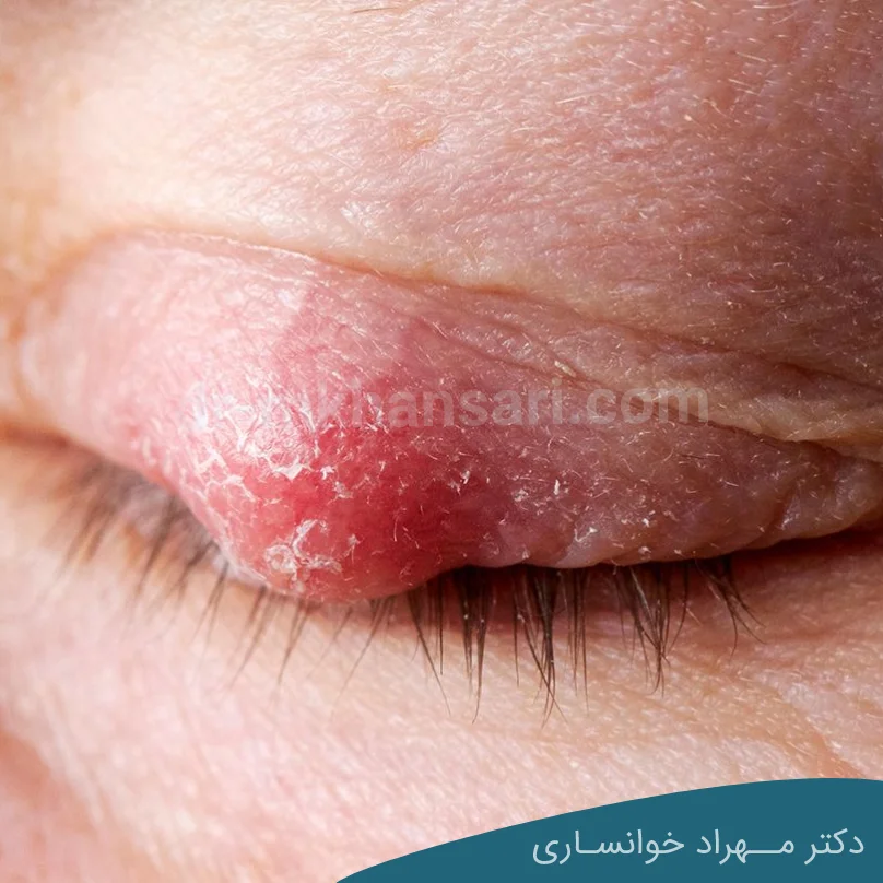 تفاوت شالازیون و گل مژه