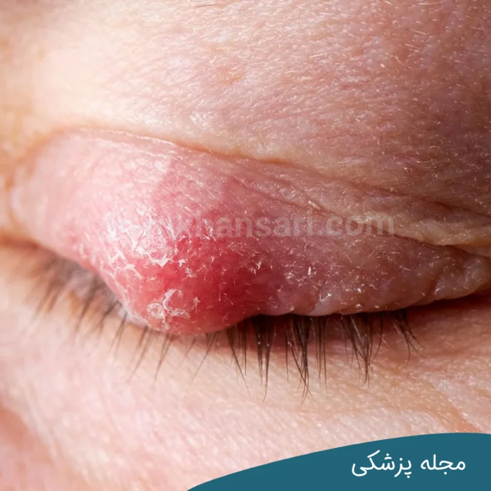 تفاوت شالازیون و گل مژه