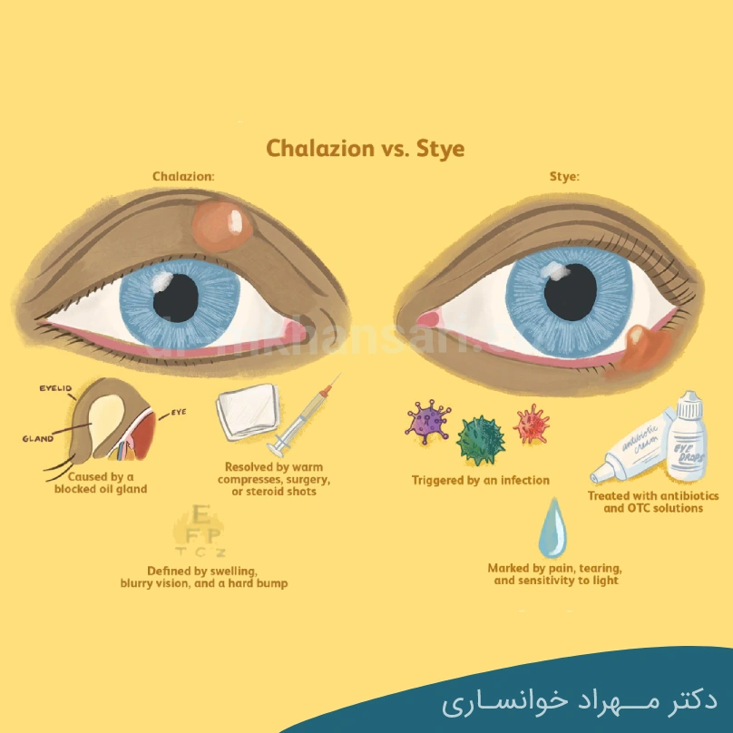 تفاوت شالازیون و گل مژه