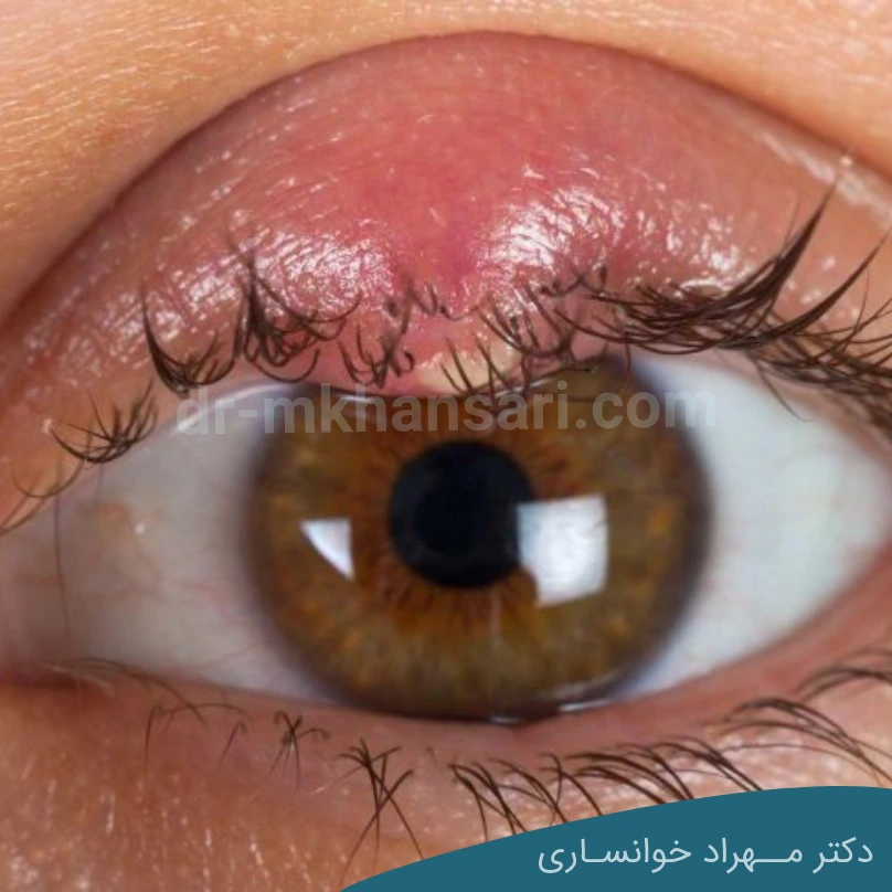 تفاوت شالازیون و گل مژه