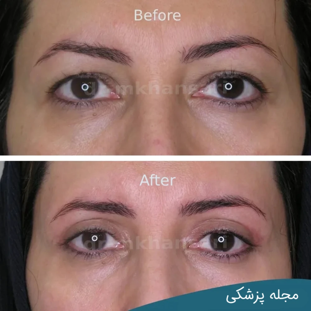 تصاویر عمل پلک چشم - dr-mkhansari.com
