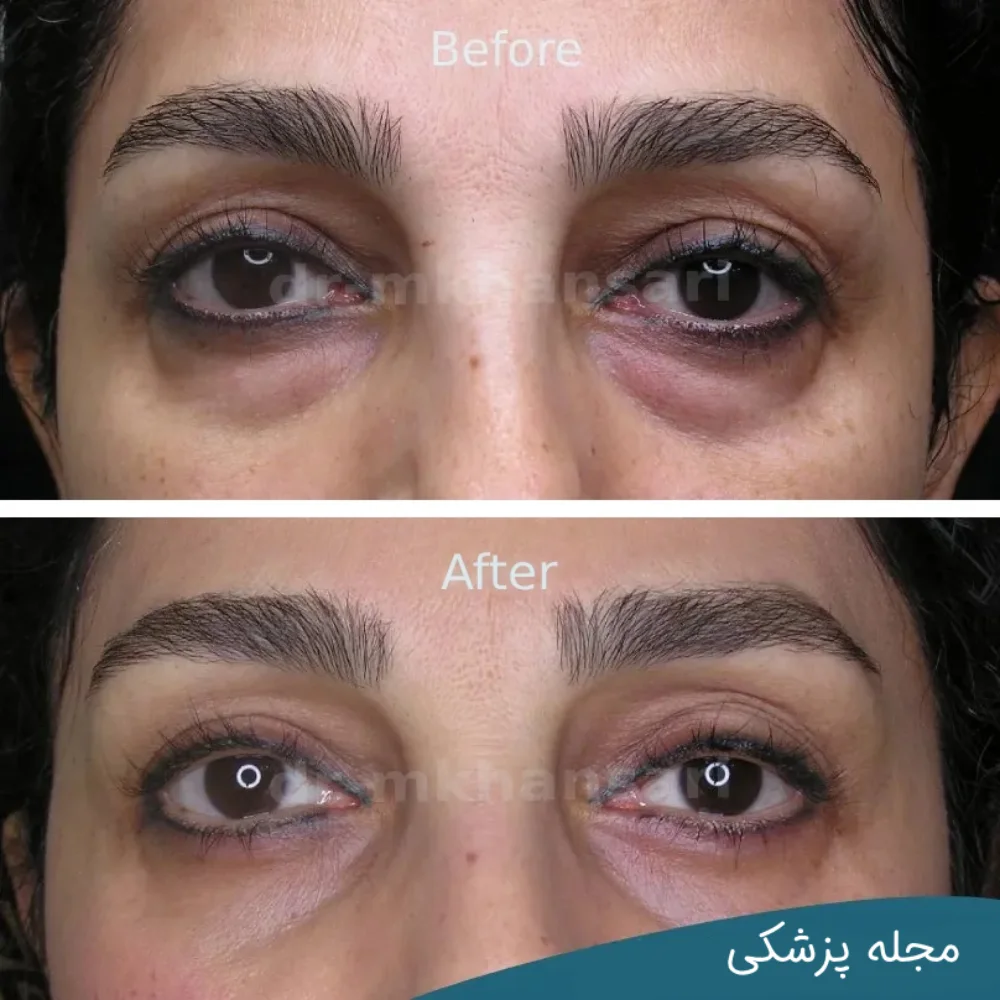 تصاویر عمل پلک چشم - دکتر مهرداد خوانساری