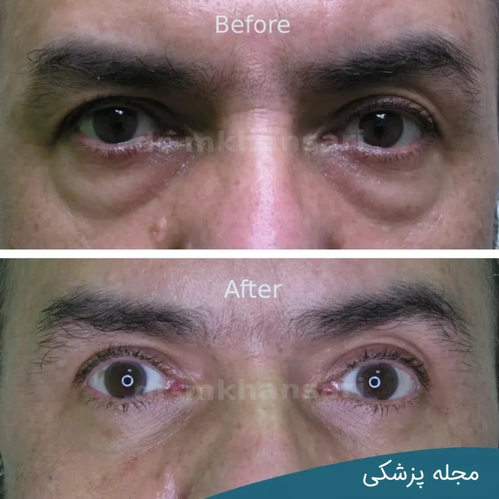 تصاویر عمل پلک چشم - دکتر مهرداد خوانساری