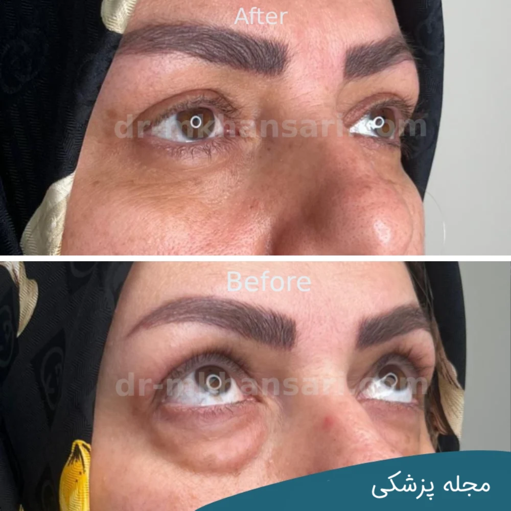 تصاویر عمل پلک چشم - dr-mkhansari