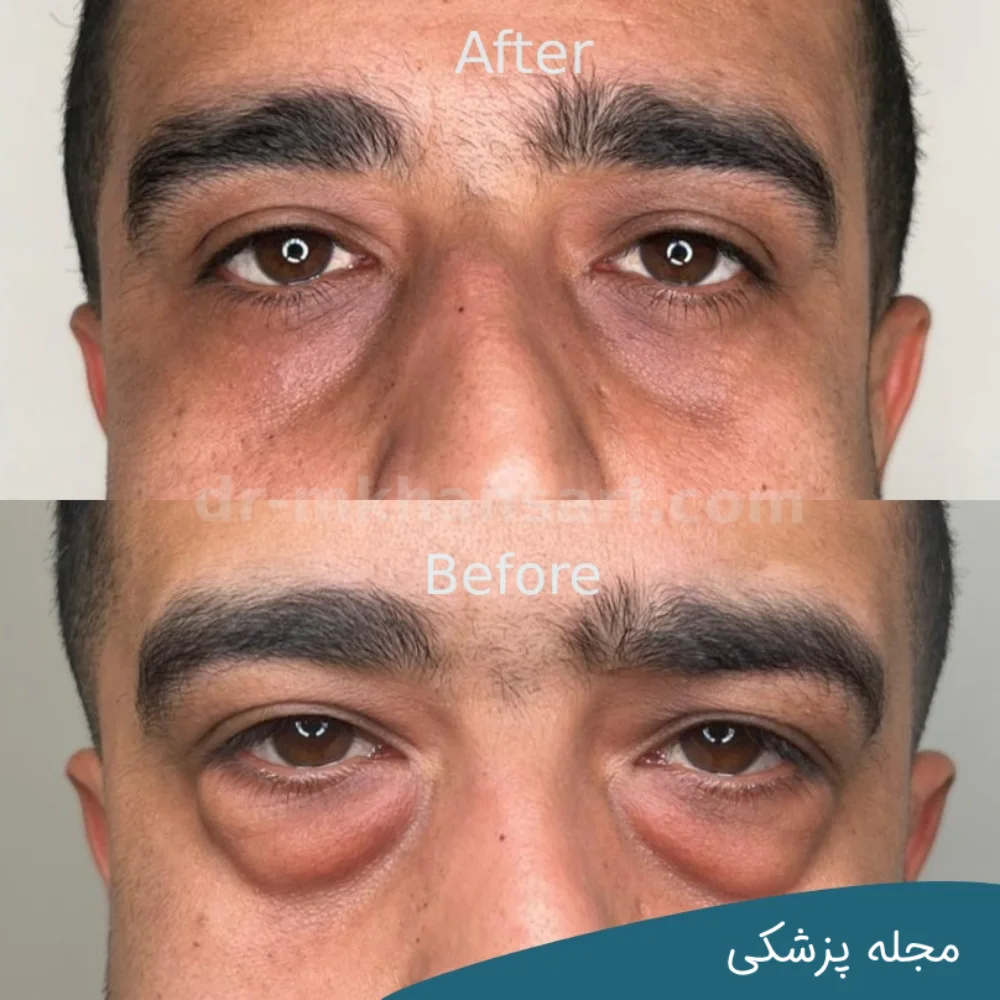 تصاویر عمل پلک چشم - dr-mkhansari