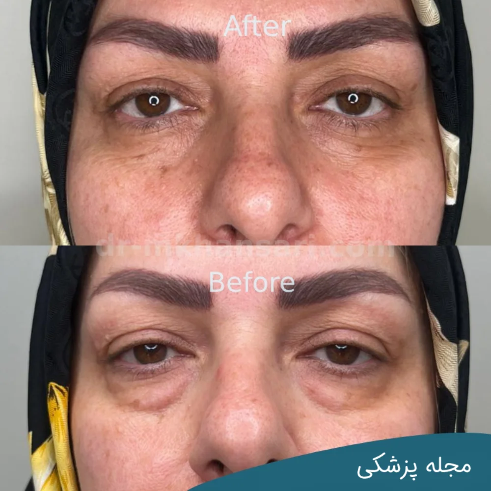 تصاویر عمل پلک چشم - dr-mkhansari