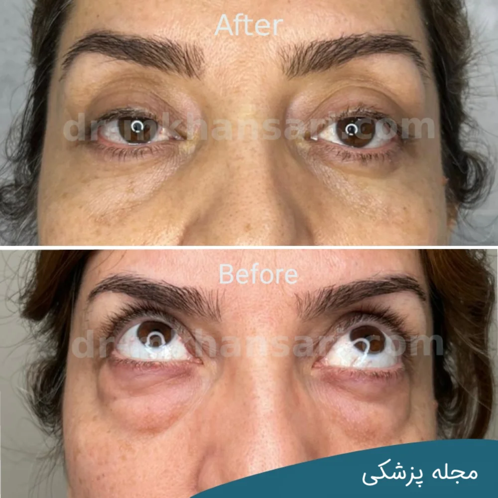 تصاویر عمل پلک چشم - dr-mkhansari