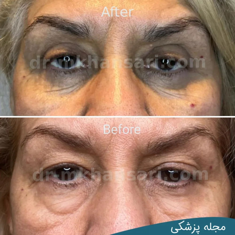 تصاویر عمل پلک چشم - dr-mkhansari