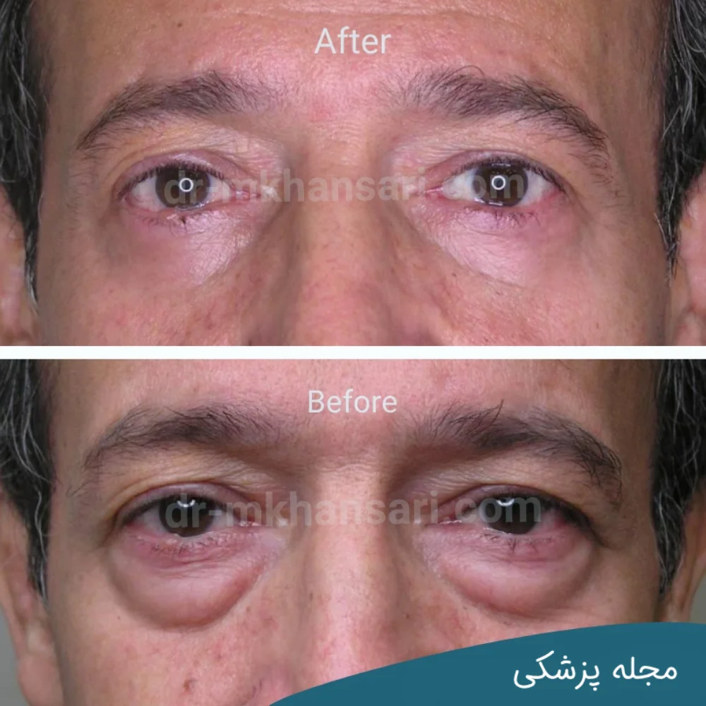 تصاویر عمل پلک چشم-dr-mkhansari