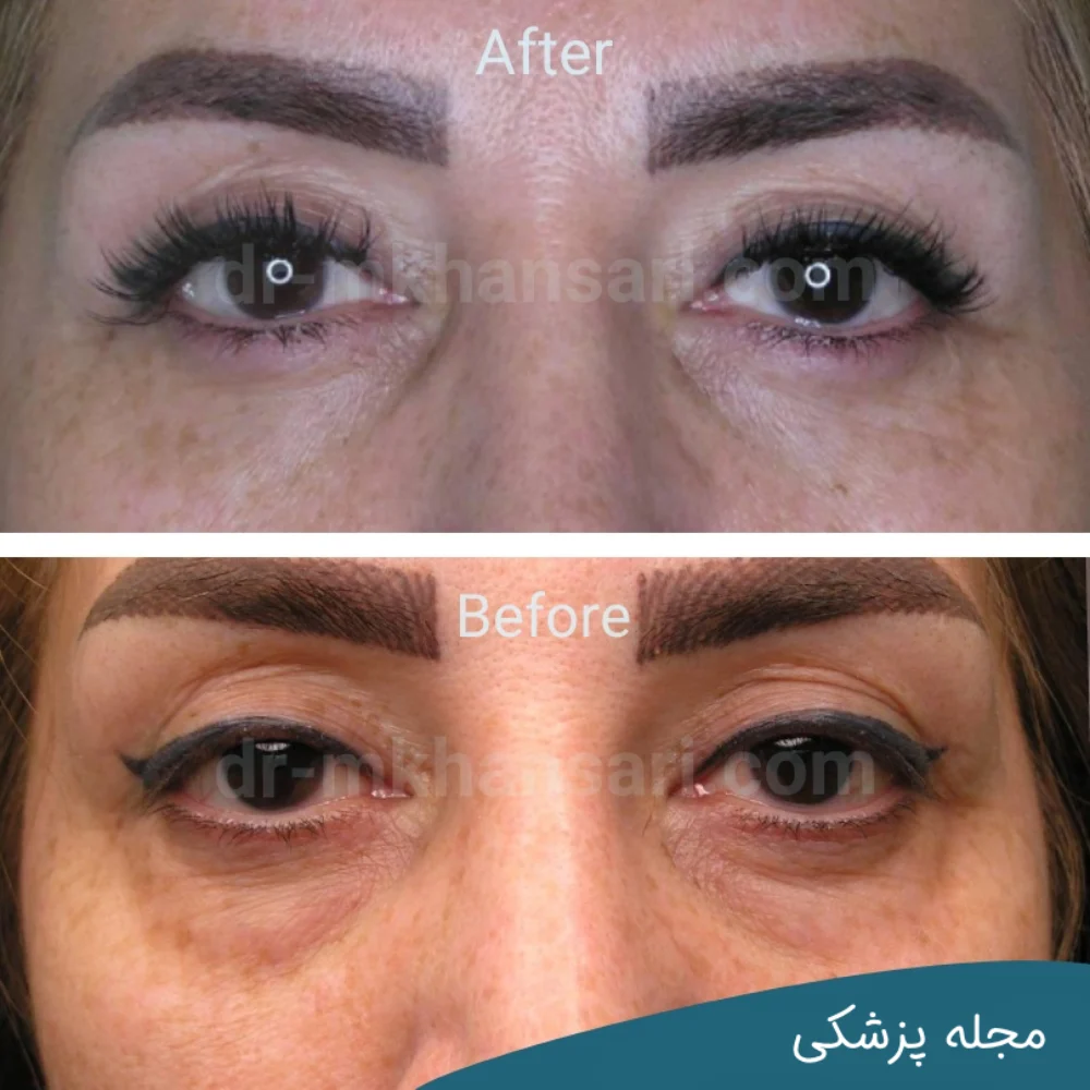 عکس عمل چشم-dr-mkhansari