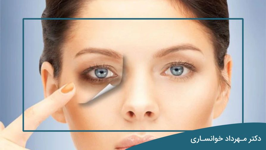 درمان تیرگی زیر چشم و رفع سیاهی دور چشم - dr-mkhansari