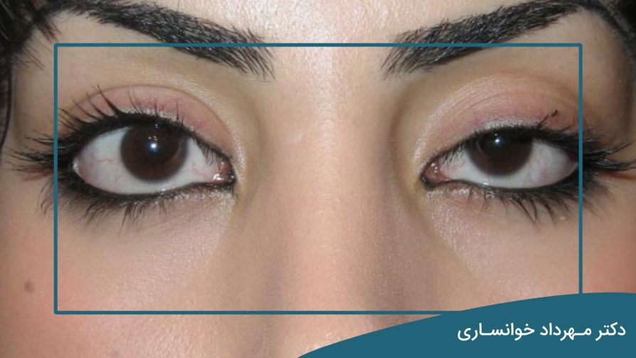 قرینه نبودن چشم بعد از عمل پلک-دکتر خوانساری