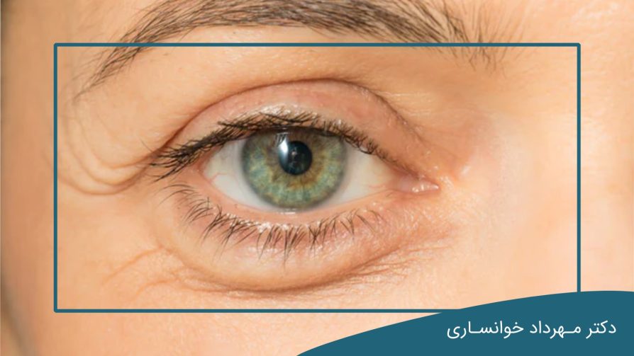 روش های درمان پف چشم-dr-mkhansari