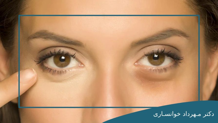 5 روش رفع فوری گودی زیر چشم-dr-mkhansari