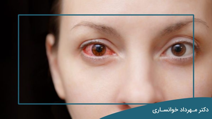 بیماری بهجت چشم - dr-mkhansari.com