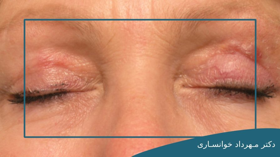 عفونت چشم بعد از جراحی بلفاروپلاستی-dr-mkhansari