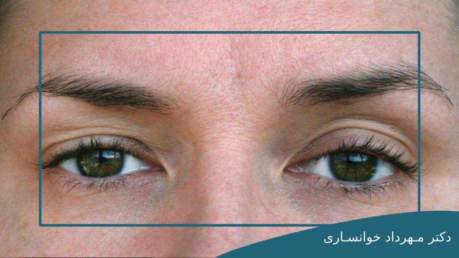 درمان افتادگی پلک با لیزر-dr-mkhansari