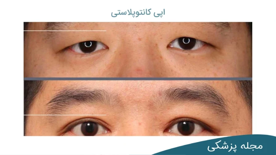 عمل جراحي بزرگ كردن چشم - دکتر مهرداد خوانساری