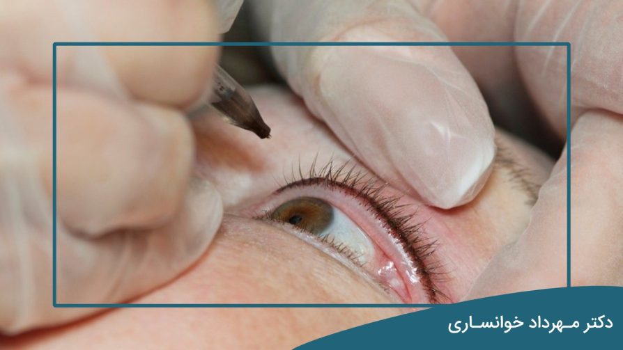 پف چشم بعد از بن مژه - دکتر مهرداد خوانساری