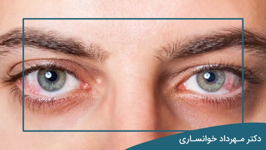ایا ناخنک چشم از بین میرود؟ - dr-mkhansari
