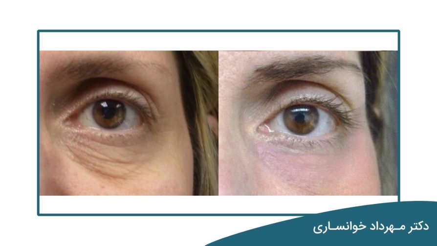 لیزر برای چروک دور چشم خوب است؟ دکتر خوانساری