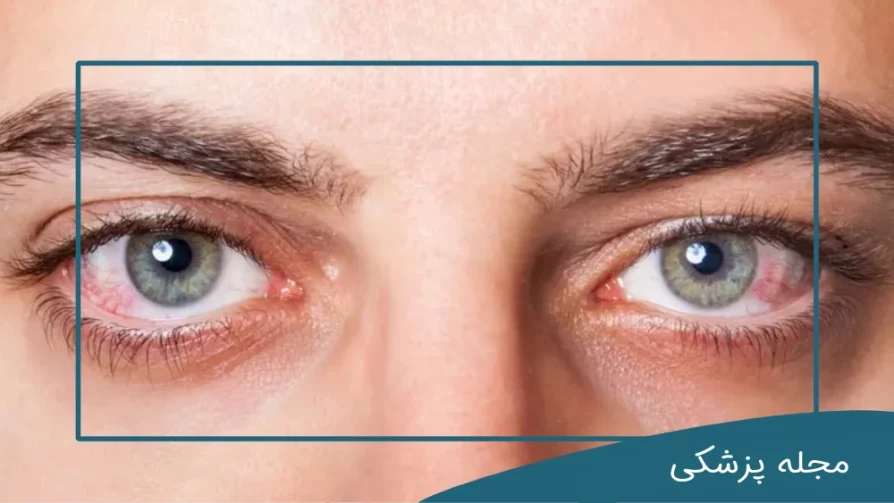 ایا ناخنک چشم از بین میرود؟ - dr-mkhansari