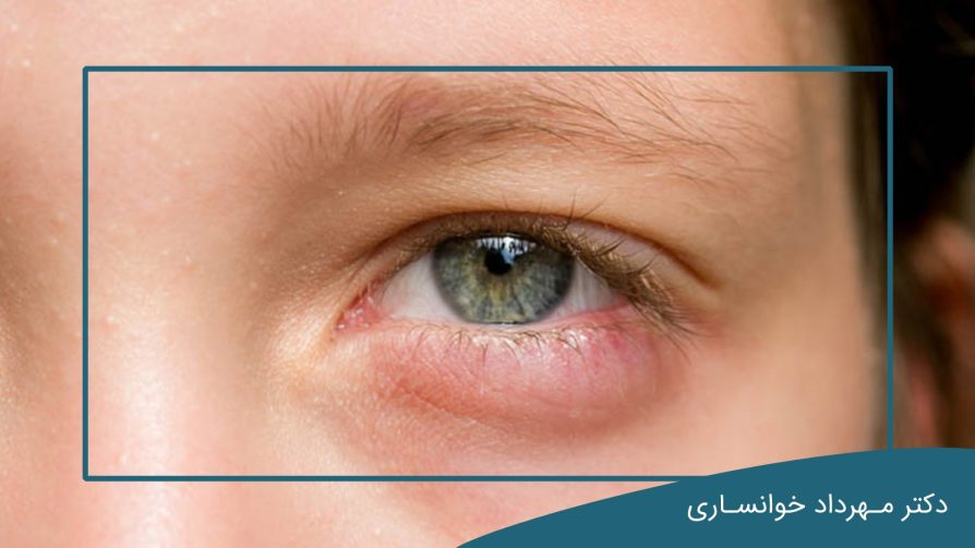 جراحی پلک پایین-dr-mkhansari.com