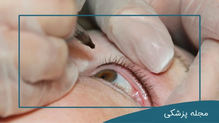پف چشم بعد از بن مژه - دکتر مهرداد خوانساری
