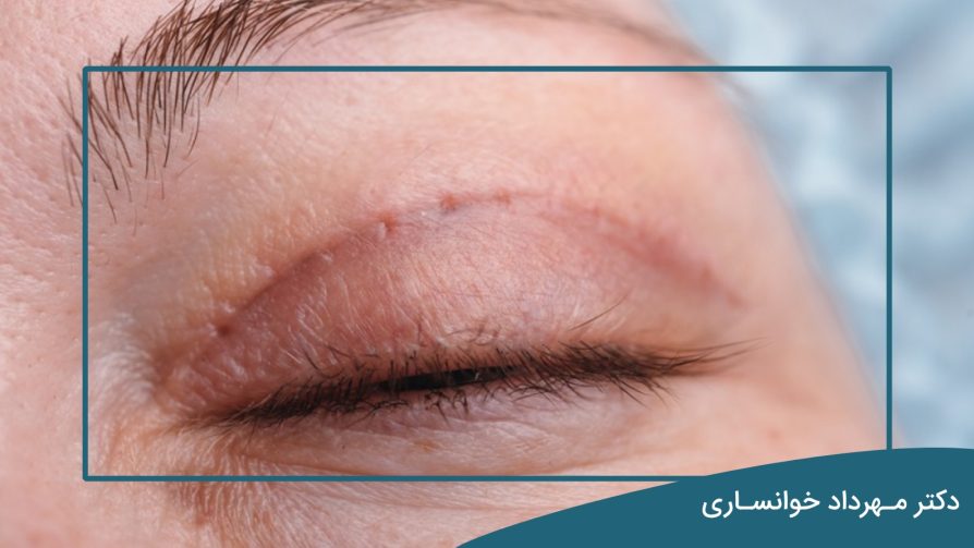گوشت اضافه بعد از بلفاروپلاستی-دکتر خوانساری