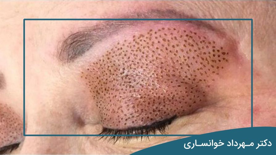 بلفاروپلاستی با لیزر-دکتر خوانساری