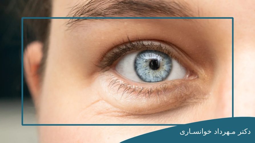 جراحی پلک-dr-mkhansari