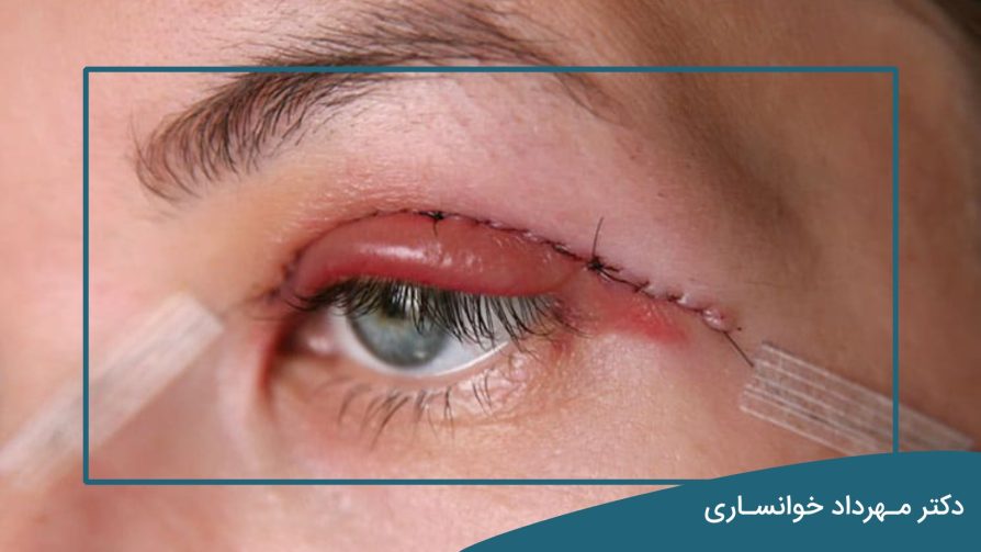 مراحل بهبود بلفاروپلاستی-دکتر خوانساری