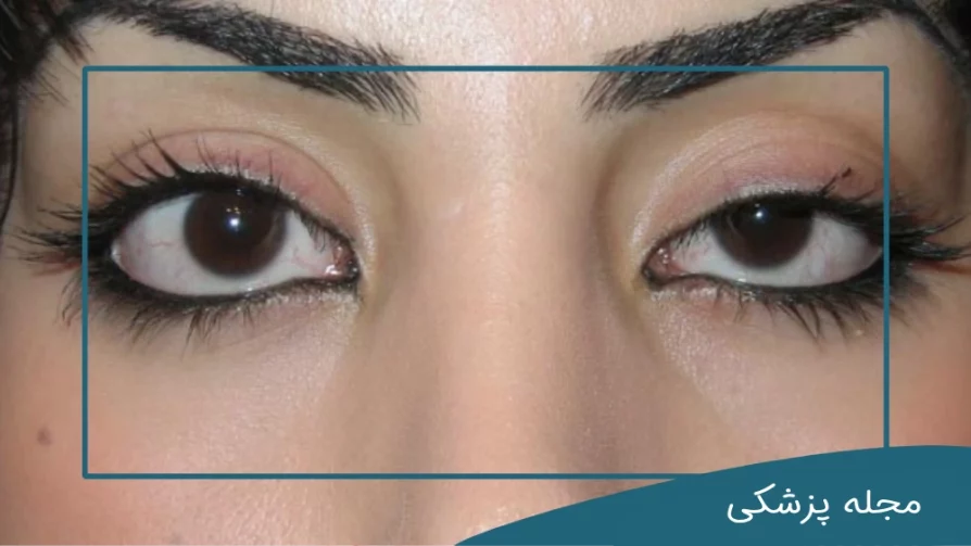 قرینه نبودن چشم بعد از عمل پلک-دکتر خوانساری