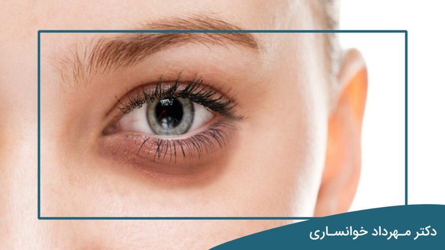 بلفاروپلاستی برای گودی چشم با دکتر خوانساری